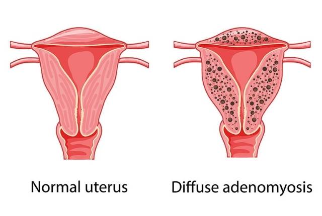 utérus normal vs utérus avec adénomyose