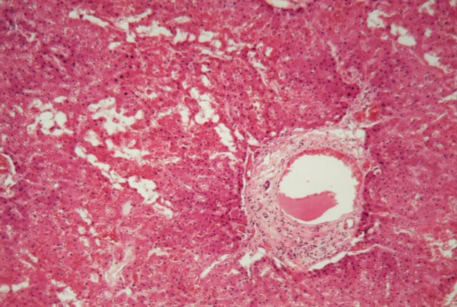 Amylose : vue au microscope d'un dépot amyloïde sur un prélèvement de foie.