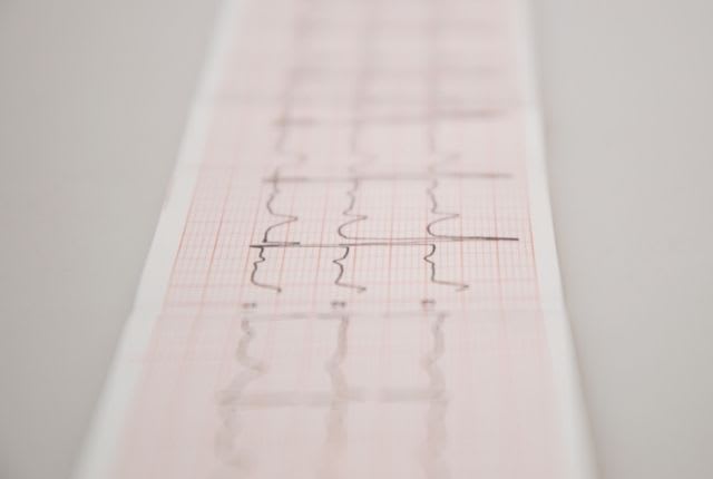 arythmie-cardiaque-1-elsan-2022