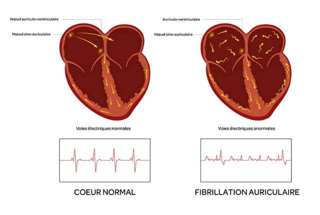 Arythmie cardiaque : définition, causes, traitement. Image de synthèse de deux cœurs avec deux courbes d'examen montrant un coeur normal d'un côté et un cœur en fibrillation de l'autre.
