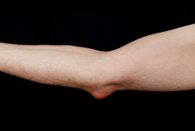 Bursite : inflammation, point rouge et douloureux au niveau du coude.