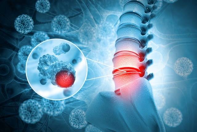 cancer des os diagnostic