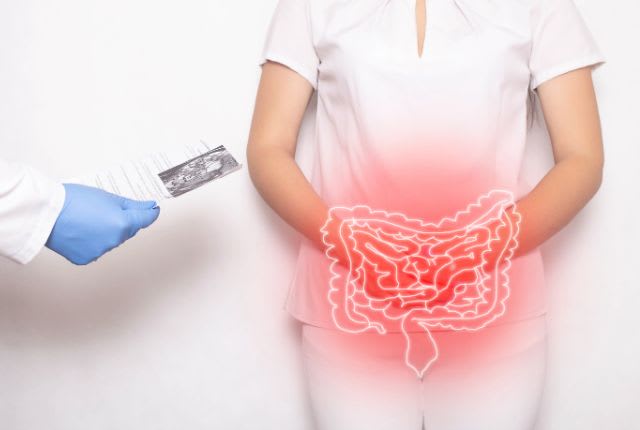 Cancer duodénal (duodénum) : un médecin examine les résultats d'une patiente atteinte d'une inflammation au niveau de l'intestin. L'intestin est dessiné par dessus l'image.