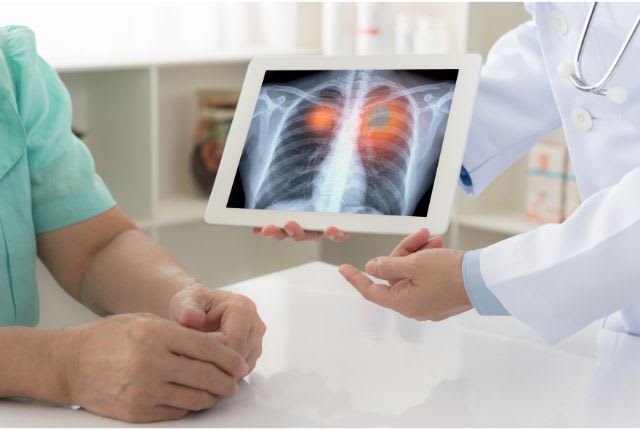 Cancer du poumon non opérable : un soignant commente le scanner du poumon de son patient sur sa tablette.