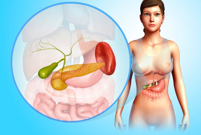 Cholécystite : définition, causes et traitements. Dessin de l'anatomie d'un être humain (une femme) et gros plan sur la vésicule biliaire, en vert, au-dessus du pancréas.