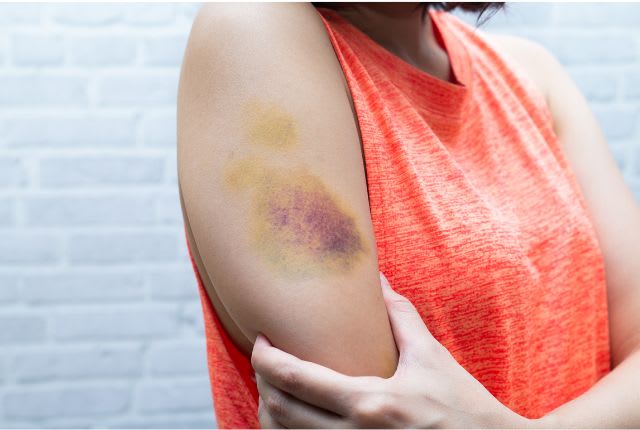 Une femme présente un bras avec un bleu caractéristique d'une contusion.