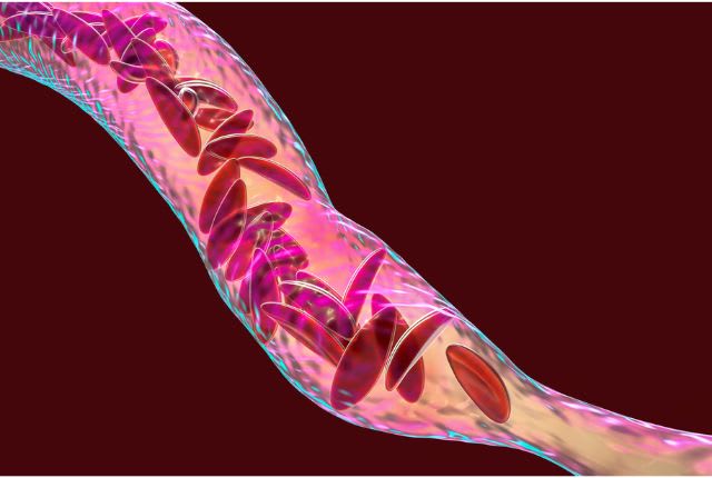Image figurant des globules rouges déformés dans une veine, effet de la drépanocytose, maladie génétique.