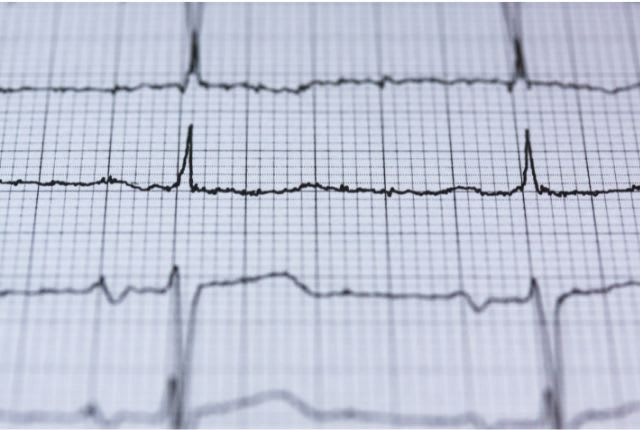 Electrocardiogramme (ECG) : image sur papier quadrillé des impulsions électriques traversant le coeur.