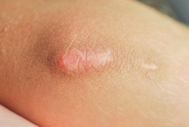 Début d'escarre sur un point d'appui du corps. Une rougeur apparaît sur la peau.