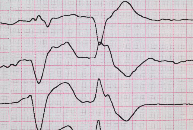 Résultat d'électrocardiogramme montrant une extrasystole.