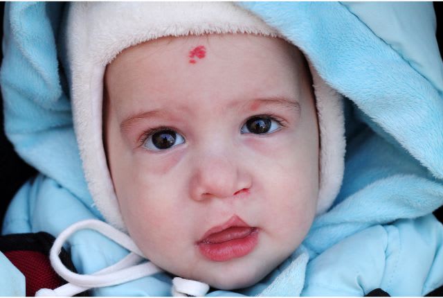 fente labio-palatine