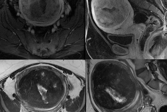 fibrome uterin