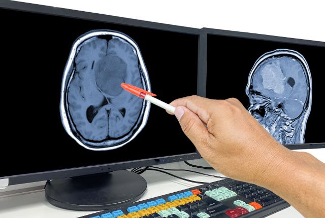Glioblastome : symptômes, cancer, guérison. Un médecin désigne une tumeur dans le cerveau sur un cliché d'IRM.