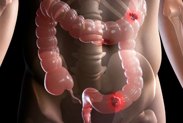 Mars bleu 2025 : dépistage du cancer colorectal. Image de synthèse d'un intestin avec des tumeurs signalées en rouge vif.