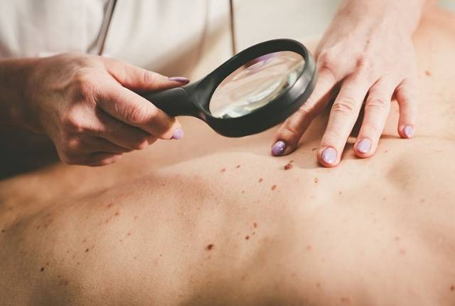 Une soignante examine des grains de beauté sur le dos d'un patient.