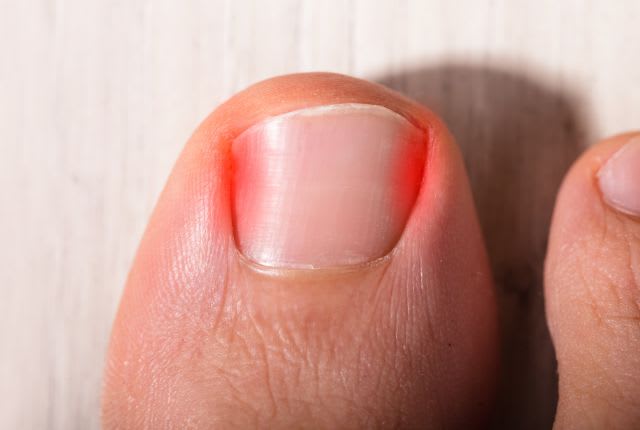 Gros plan sur l'ongle douloureux d'un orteil.