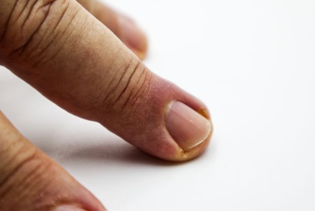Panaris sur l'ongle d'un doigt. Un panaris est une infection de la peau, et, plus précisément, des tissus mous des extrémités des doigts.