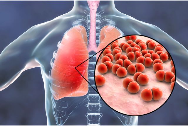 Pneumonie aiguë : figuration en image de synthèse de poumons infectés par des germes.