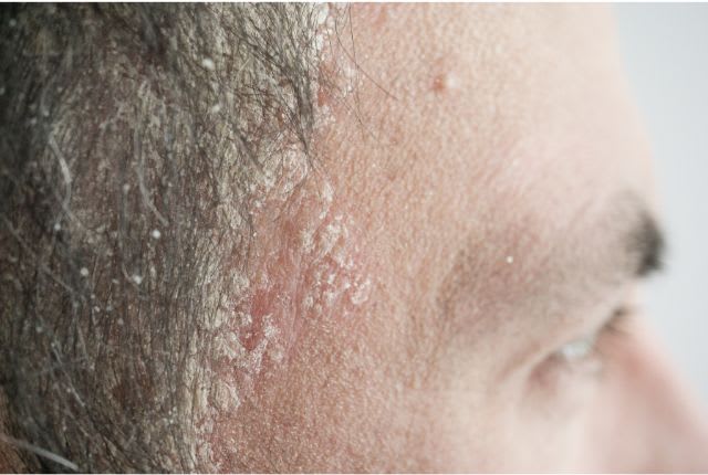 Un homme atteint de psoriasis du cuir chevelu : plaques rouges et pellicules blanches.