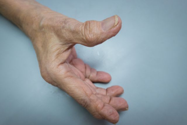 rhizarthrose : pouce déformé d'une personne âgée