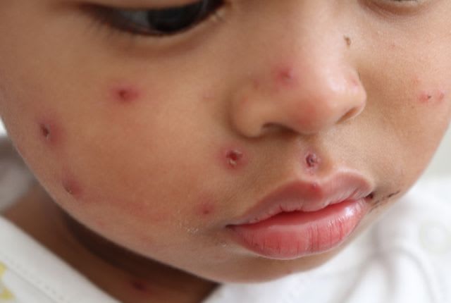 Rougeole : sa recrudescence en 2025 inquiète. Gros plan sur le visage d'un enfant, parsemé de boutons rouges.