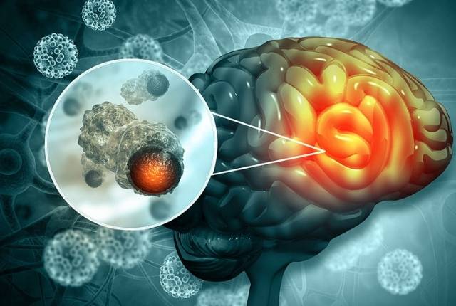tumeur au cerveau diagnostic