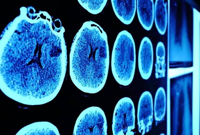 tumeur au cerveau