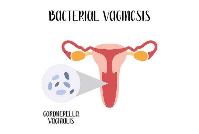 vaginose causes