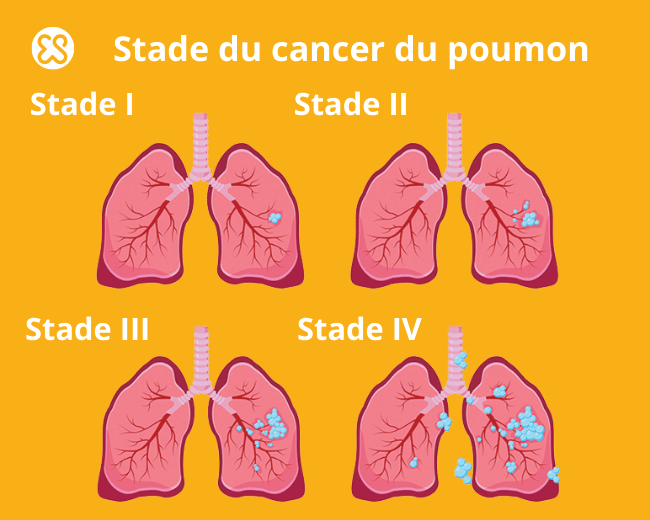 stade cancer poumon
