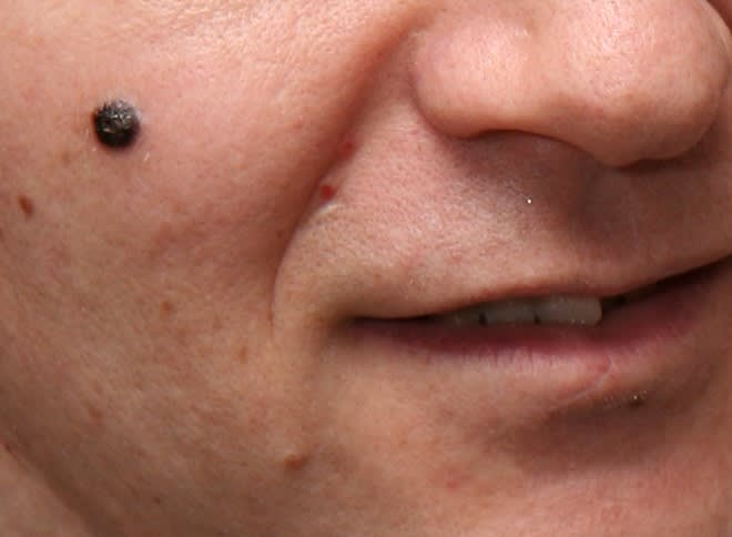 Image d'un mélanome nodulaire sur un visage. Licence Creative commons.