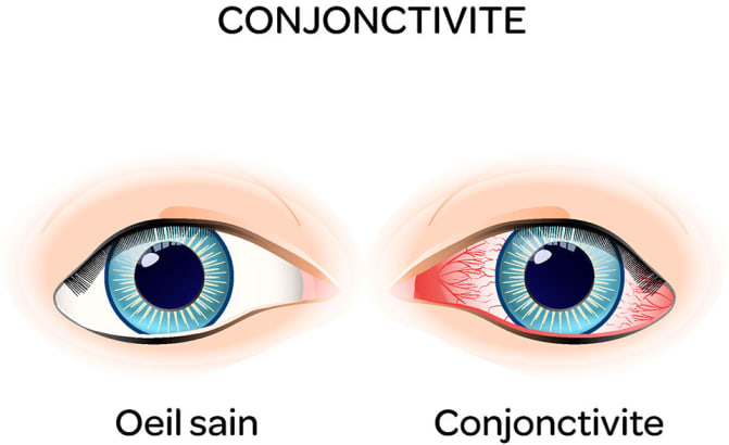 Comparaison entre un œil sain et un œil frappé de conjonctivite, dont la sclère est rougie