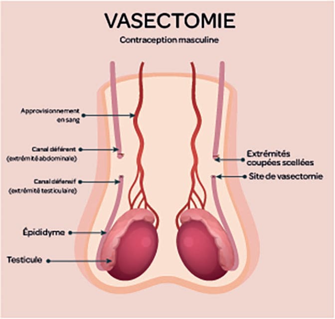 vasectomie