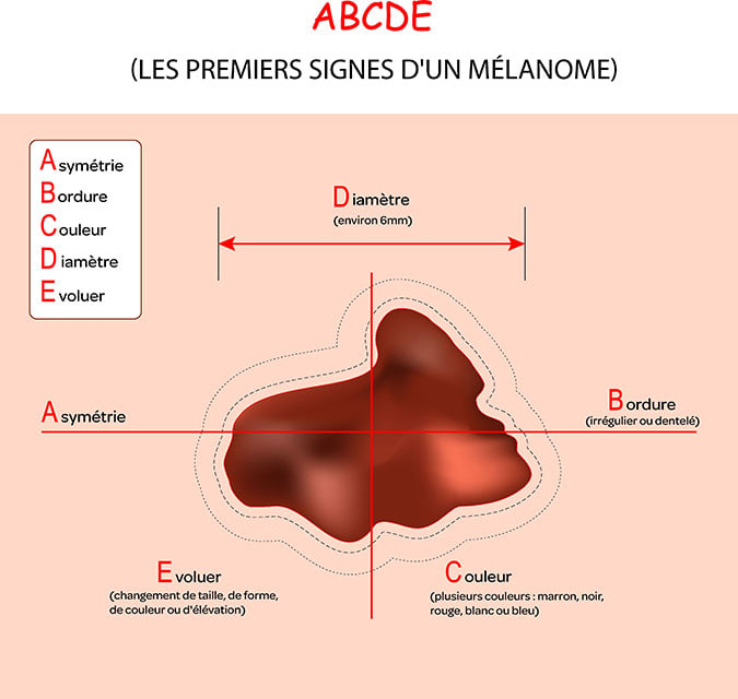 Détecter un mélanome. Graphique sur la méthode ABCDE pour repérer une tache ou un grain de beauté suspect.
