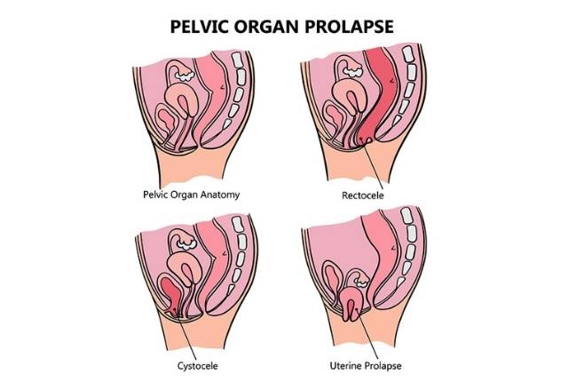 prolapsus symptomes
