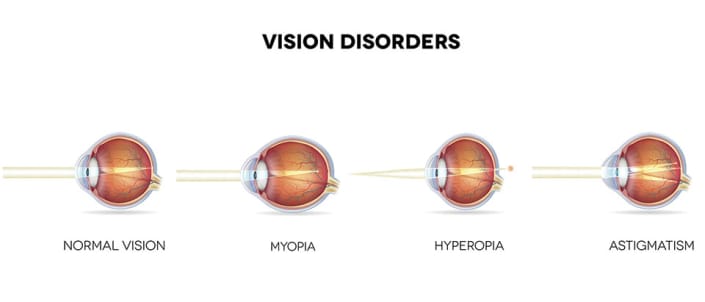 Schéma comparant la vision normale, la myopie, l’hypermétropie et l’astigmatisme, montrant la position du foyer lumineux par rapport à la rétine dans chaque trouble visuel.