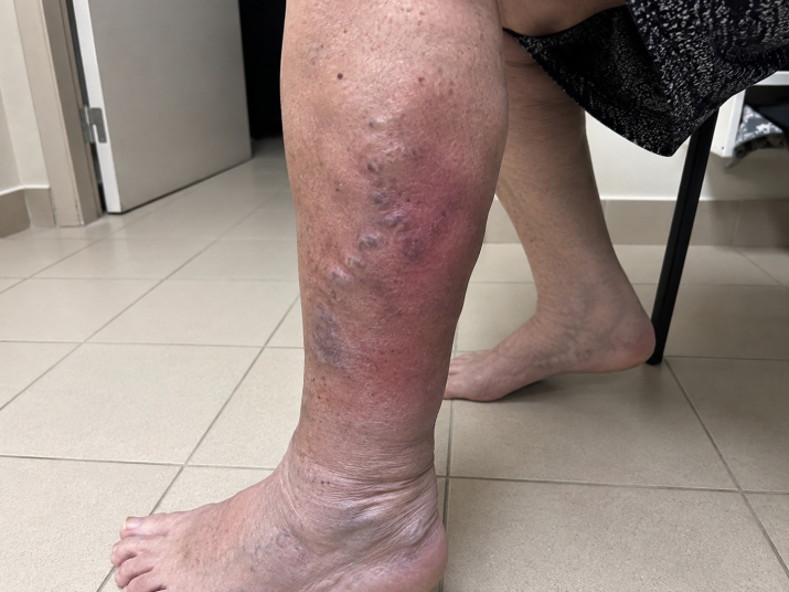 thrombose veineuse sur le mollet