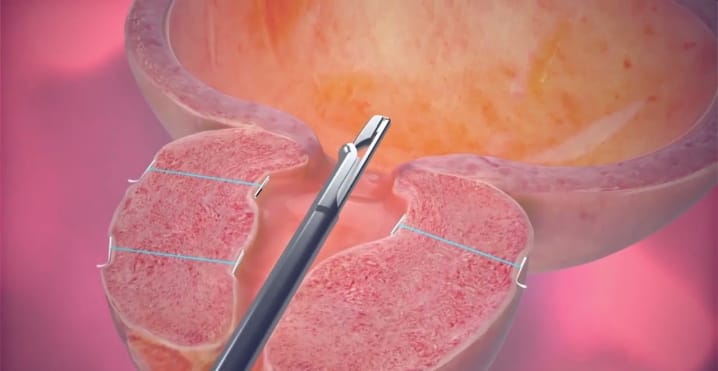 urolift