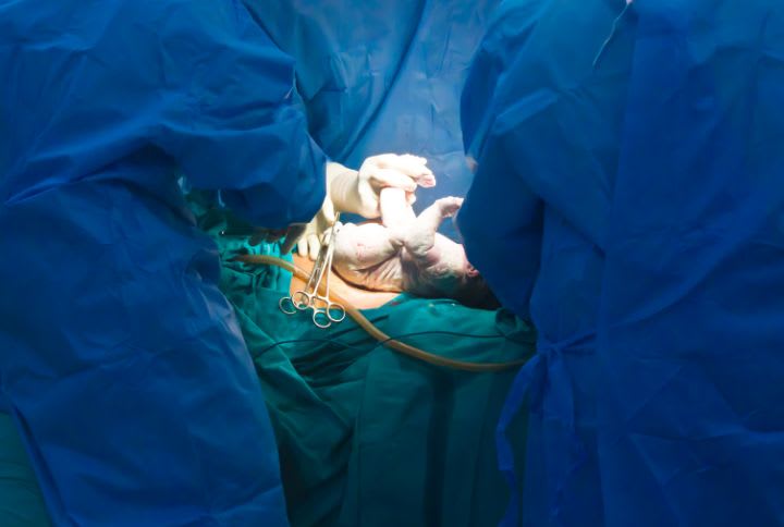 Césarienne programmée : image d'un nouveau-né extrait de l'utérus par le biais d'une césarienne.