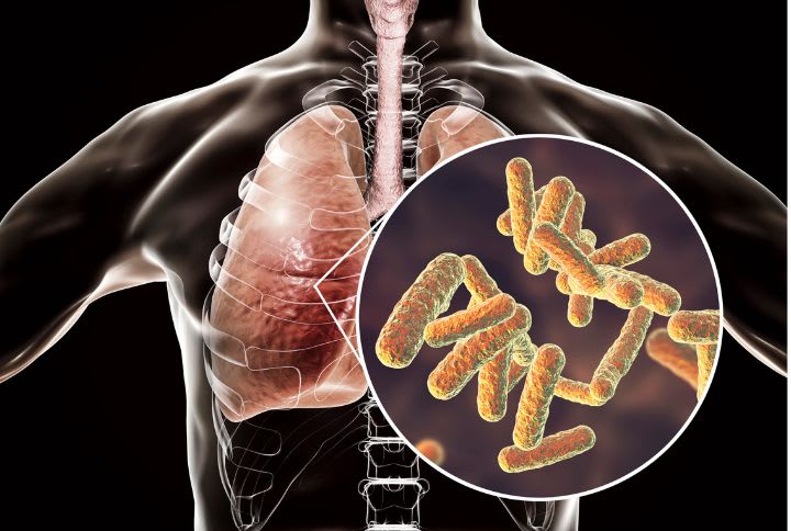 Comprendre la pneumopathie bactérienne : image de poumons et de bactéries.