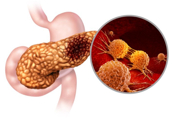 Dépistage du cancer du pancréas : image de synthèse figurant un cancer pancréatique.