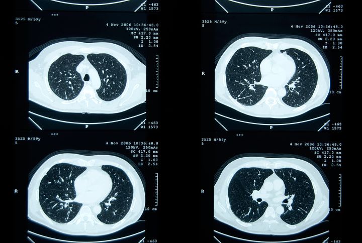 nodule pulmonaire : définition, symptômes, scanner. Images ou taches de nodules sur des clichés de scanner.