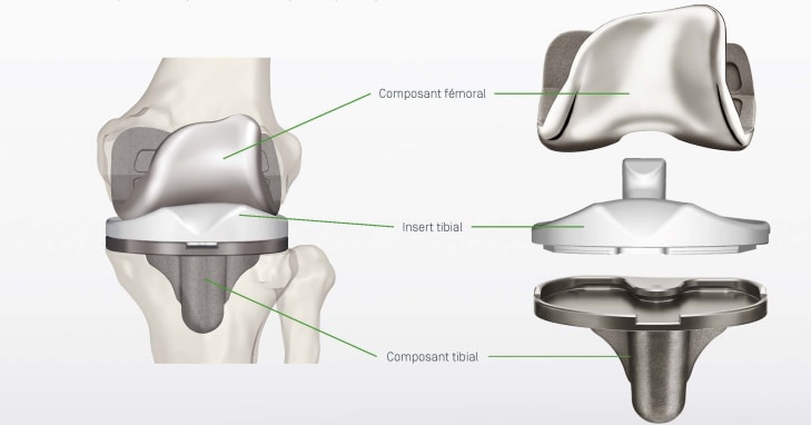 Prothèse genou sur mesure