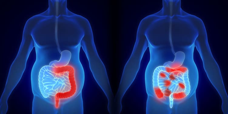 maladie de Crohn schéma