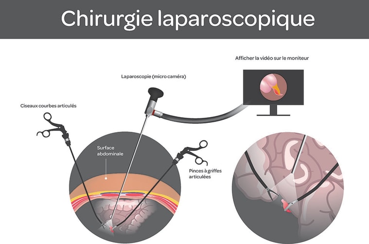 coelioscopie schema