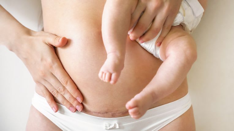 Cicatrice césarienne - Image d'une cicatrice césarienne au niveau du bas-ventre d'une femme. La femme tient son bébé dans sa main gauche.