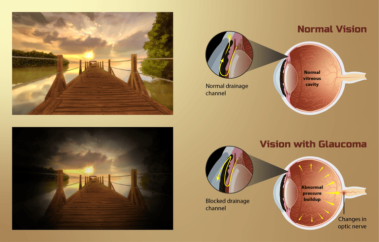 vision glaucome