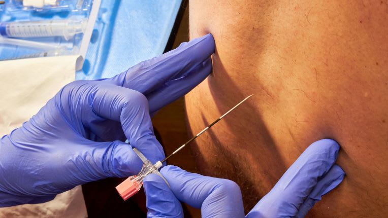 Péridurale : image d'un médecin réalisant une péridurale à l'aide d'une aiguille