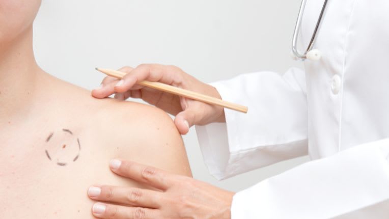 Tache rouge sur la peau - Image d'un médecin examinant une tache rouge située sur la clavicule d'une patiente femme. Le médecin recherche un cancer de la peau potentiel.