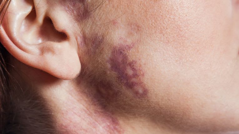 Photo d'un angiome plan ou tache de vin en dessous de l'oreille d'une femme devenue adulte.