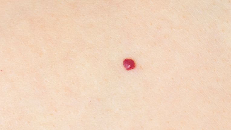 Photo d'un angiome rubis ou cerise chez un adulte